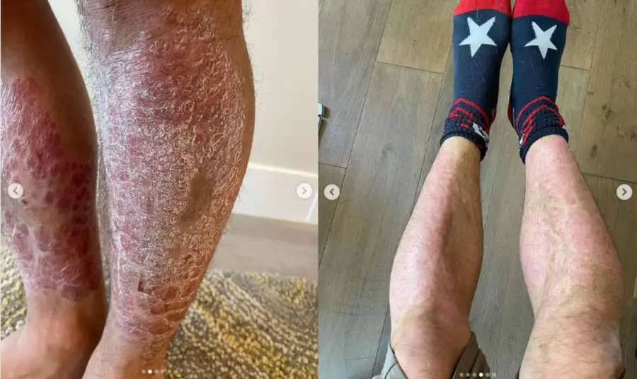 Images from Chad Mendes Instagram post - one of his scaly skin leg and one of his legs with much better skin condition