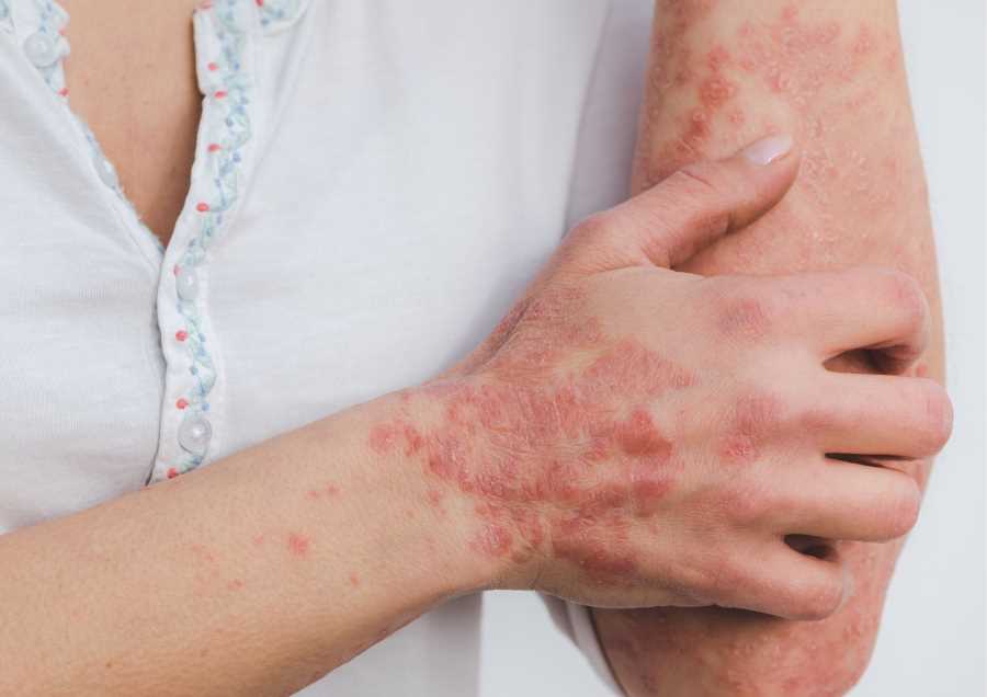 Can the Carnivore Diet Fix Psoriasis?