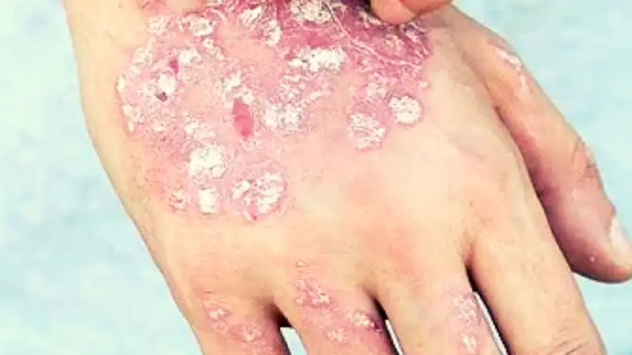 Can the Carnivore Diet Help Fix Your Eczema?